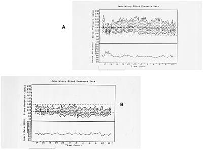 Pheochromocytomas and Paragangliomas as Causes of Endocrine Hypertension